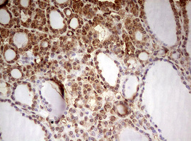 IHC of paraffin-embedded Carcinoma of Human thyroid tissue using anti-FBXW7 mouse monoclonal antibody. (Heat-induced epitope retrieval by 10mM citric buffer, pH6.0, 120°C for 3min).