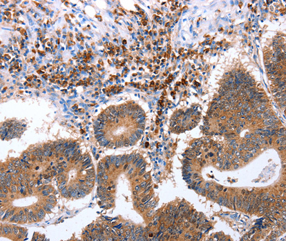 Immunohistochemistry of paraffin-embedded human colon cancer tissue using CNTFR antibody.