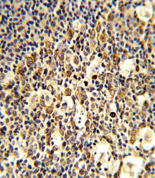Formalin-fixed and paraffin-embedded human tonsil reacted with FCGR1B Antibody , which was peroxidase-conjugated to the secondary antibody, followed by DAB staining. This data demonstrates the use of this antibody for immunohistochemistry; clinical relevance has not been evaluated.