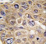 Formalin-fixed and paraffin-embedded human hepatocarcinoma tissue reacted with FDFT1 Antibody , which was peroxidase-conjugated to the secondary antibody, followed by DAB staining. This data demonstrates the use of this antibody for immunohistochemistry; clinical relevance has not been evaluated.