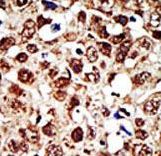 Formalin-fixed and paraffin-embedded human cancer tissue reacted with the primary antibody, which was peroxidase-conjugated to the secondary antibody, followed by DAB staining. This data demonstrates the use of this antibody for immunohistochemistry; clinical relevance has not been evaluated. BC = breast carcinoma; HC = hepatocarcinoma.