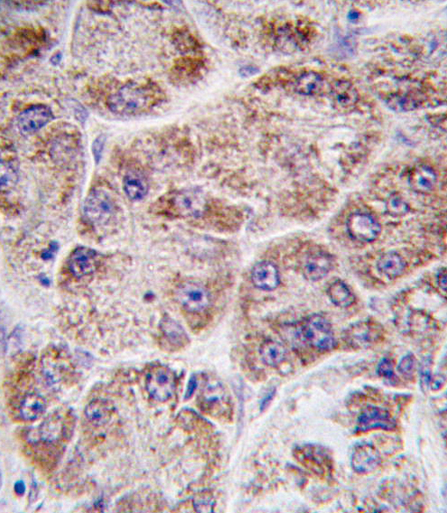 Formalin-fixed and paraffin-embedded human hepatocarcinoma tissue reacted with FDPS antibody (Center ), which was peroxidase-conjugated to the secondary antibody, followed by DAB staining. This data demonstrates the use of this antibody for immunohistochemistry; clinical relevance has not been evaluated.