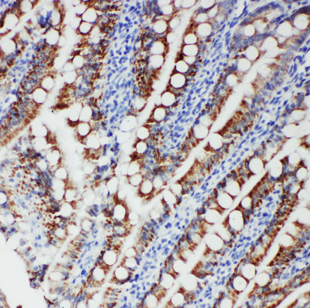 FER antibody. IHC(P): Human Intestinal Cancer Tissue.
