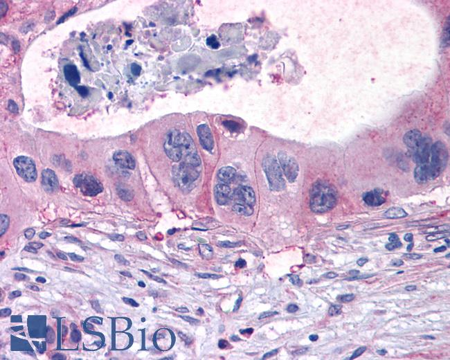 Anti-FFAR1 / GPR40 antibody IHC of human Pancreas, Carcinoma. Immunohistochemistry of formalin-fixed, paraffin-embedded tissue after heat-induced antigen retrieval.