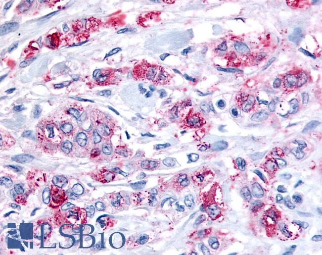 Anti-FFAR2 / GPR43 antibody IHC of human Pancreas, Carcinoma. Immunohistochemistry of formalin-fixed, paraffin-embedded tissue after heat-induced antigen retrieval.
