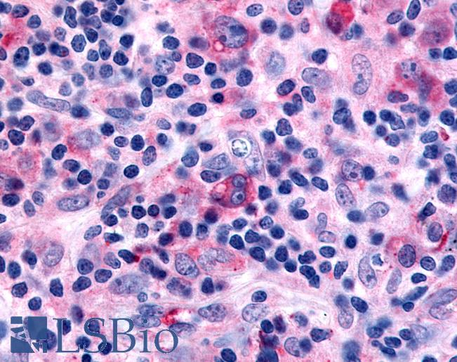 Anti-FFAR2 / GPR43 antibody IHC of human Lymph Node, Hodgkins Lymphoma. Immunohistochemistry of formalin-fixed, paraffin-embedded tissue after heat-induced antigen retrieval.