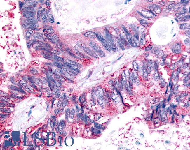 Anti-FFAR2 / GPR43 antibody IHC of human Colon, Carcinoma. Immunohistochemistry of formalin-fixed, paraffin-embedded tissue after heat-induced antigen retrieval.