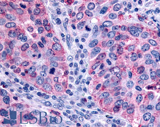 Anti-FFAR2 / GPR43 antibody IHC of human lung carcinoma. Immunohistochemistry of formalin-fixed, paraffin-embedded tissue after heat-induced antigen retrieval.
