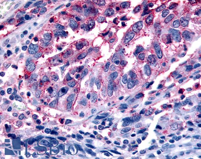 Anti-FFAR2 / GPR43 antibody IHC of human Ovary, Carcinoma. Immunohistochemistry of formalin-fixed, paraffin-embedded tissue after heat-induced antigen retrieval.