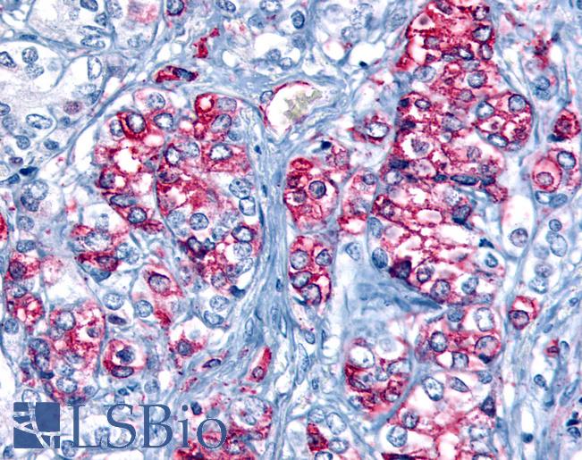 Anti-FFAR2 / GPR43 antibody IHC of human Prostate, Carcinoma. Immunohistochemistry of formalin-fixed, paraffin-embedded tissue after heat-induced antigen retrieval.