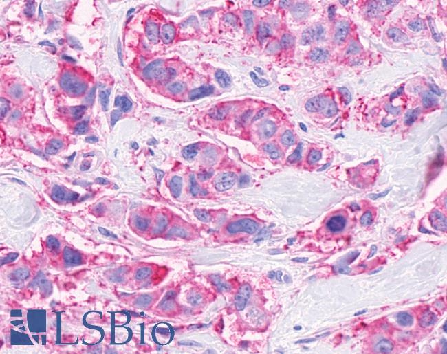 Anti-FFAR3 / GPR41 antibody IHC of human Breast, Carcinoma. Immunohistochemistry of formalin-fixed, paraffin-embedded tissue after heat-induced antigen retrieval.