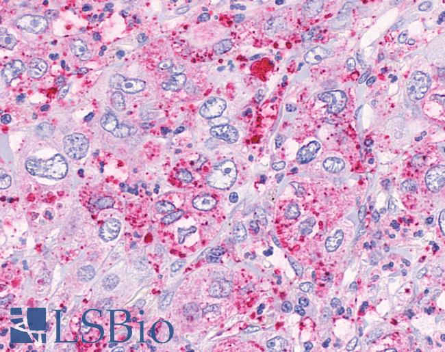 Anti-FFAR3 / GPR41 antibody IHC of human Lung, Adenocarcinoma. Immunohistochemistry of formalin-fixed, paraffin-embedded tissue after heat-induced antigen retrieval.