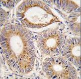 Formalin-fixed and paraffin-embedded human colon carcinoma tissue reacted with FGF1 antibody , which was peroxidase-conjugated to the secondary antibody, followed by DAB staining. This data demonstrates the use of this antibody for immunohistochemistry; clinical relevance has not been evaluated.