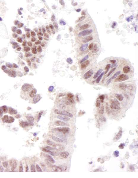 Detection of Human CoAA by Immunohistochemistry. Sample: FFPE section of human stomach carcinoma. Antibody: Affinity purified rabbit anti-CoAA used at a dilution of 1:1000 (1 ug/ml).