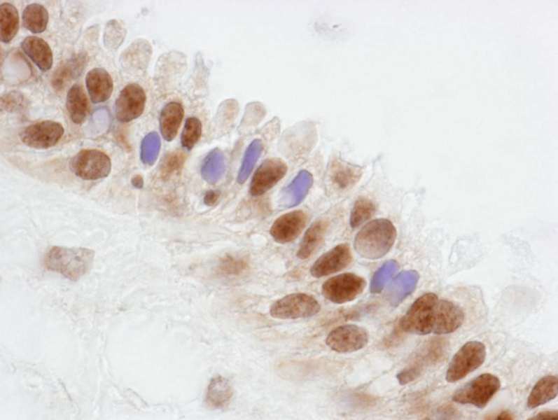 Detection of Human CoAA by Immunohistochemistry. Sample: FFPE section of human breast. Antibody: Affinity purified rabbit anti-CoAA used at a dilution of 1:250. Detection: DAB.