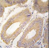 Formalin-fixed and paraffin-embedded human colon carcinoma tissue reacted with FGF4 Antibody , which was peroxidase-conjugated to the secondary antibody, followed by DAB staining. This data demonstrates the use of this antibody for immunohistochemistry; clinical relevance has not been evaluated.