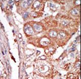 Formalin-fixed and paraffin-embedded human cancer tissue reacted with the primary antibody, which was peroxidase-conjugated to the secondary antibody, followed by DAB staining. This data demonstrates the use of this antibody for immunohistochemistry; clinical relevance has not been evaluated. BC = breast carcinoma; HC = hepatocarcinoma.