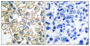 IHC of paraffin-embedded human breast carcinoma tissue, using FGFR1 Oncogene Partner Antibody. The picture on the right is treated with the synthesized peptide.