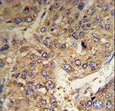 FGG Antibody (RB18714) IHC of formalin-fixed and paraffin-embedded human hepatocarcinoma tissue followed by peroxidase-conjugated secondary antibody and DAB staining.
