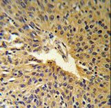 COG2 Antibody (RB17913) IHC of formalin-fixed and paraffin-embedded human Lung carcinoma followed by peroxidase-conjugated secondary antibody and DAB staining.