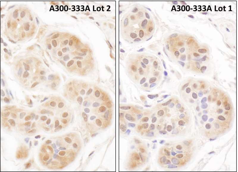 Detection of Human FHL2 by Immunohistochemistry. Sample: FFPE sections of human breast carcinoma. Antibody: Affinity purified rabbit anti-FHL2 ( Lot2 - left and Lot1 - right) used at a dilution of 1:1000 (1 Detection: DAB.