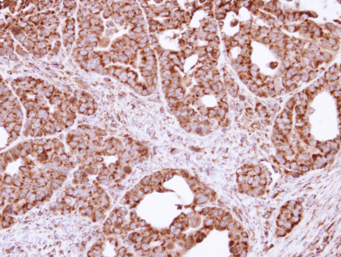 IHC of paraffin-embedded NCIN87 xenograft using FIS1 antibody at 1:100 dilution.