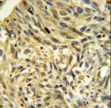 FKBP14 Antibody IHC of formalin-fixed and paraffin-embedded human Lung carcinoma followed by peroxidase-conjugated secondary antibody and DAB staining.