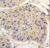Formalin-fixed and paraffin-embedded human lung carcinoma tissue reacted with FKBP12 antibody , which was peroxidase-conjugated to the secondary antibody, followed by DAB staining. This data demonstrates the use of this antibody for immunohistochemistry; clinical relevance has not been evaluated.