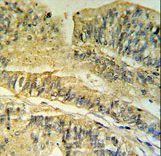 FKBP2 Antibody IHC of formalin-fixed and paraffin-embedded human Colon carcinoma followed by peroxidase-conjugated secondary antibody and DAB staining.