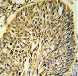 FKBP9 Antibody IHC of formalin-fixed and paraffin-embedded human Lung carcinoma followed by peroxidase-conjugated secondary antibody and DAB staining.