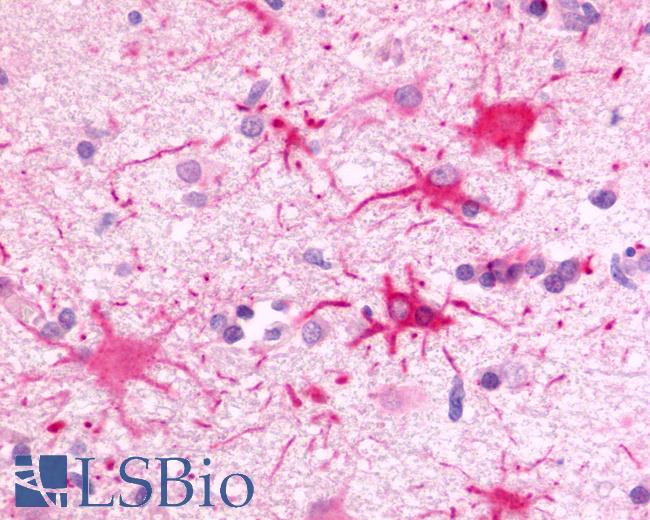 Anti-FKSG80 / GPR81 antibody IHC of human Brain, Glioblastoma. Immunohistochemistry of formalin-fixed, paraffin-embedded tissue after heat-induced antigen retrieval.