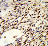 Formalin-fixed and paraffin-embedded human lung carcinoma reacted with FLCN Antibody , which was peroxidase-conjugated to the secondary antibody, followed by DAB staining. This data demonstrates the use of this antibody for immunohistochemistry; clinical relevance has not been evaluated.