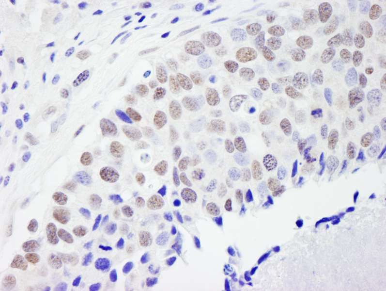 Detection of Human CPSF59 by Immunohistochemistry. Sample: FFPE section of human breast carcinoma. Antibody: Affinity purified rabbit anti-CPSF59 used at a dilution of 1:500 (2 ug/ml). Detection: DAB.