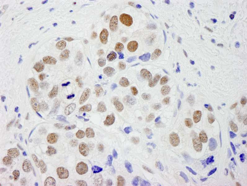 Detection of Human CPSF59 by Immunohistochemistry. Sample: FFPE section of human breast carcinoma. Antibody: Affinity purified rabbit anti-CPSF59 used at a dilution of 1:250.
