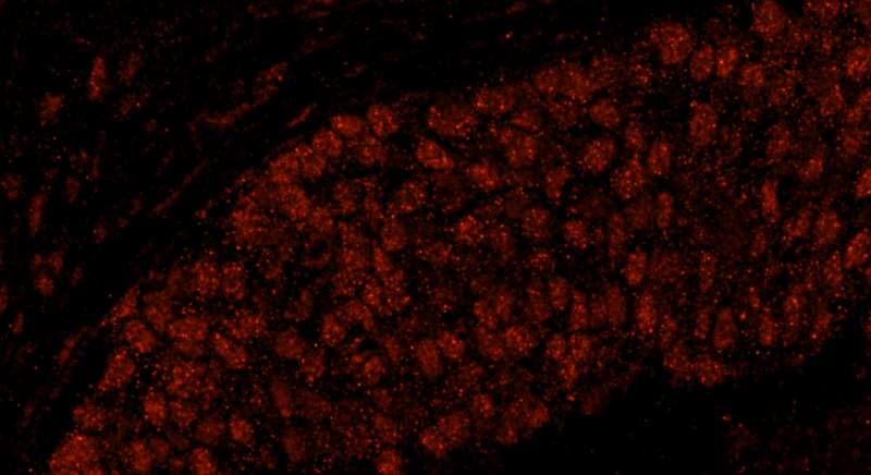 Detection of Human CPSF59 by Immunofluorescence. Sample: FFPE section of human breast carcinoma. Antibody: Affinity purified rabbit anti-CPSF59 used at a dilution of 1:100. Detection: Red-fluorescent goat anti-rabbit IgG highly cross-adsorbed Antibody used at a dilution of 1:100.