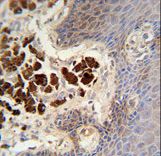 COL19A1 antibody immunohistochemistry of formalin-fixed and paraffin-embedded human skin carcinoma followed by peroxidase-conjugated secondary antibody and DAB staining.