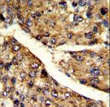 Formalin-fixed and paraffin-embedded human hepatocarcinoma reacted with FMO3 Antibody , which was peroxidase-conjugated to the secondary antibody, followed by DAB staining. This data demonstrates the use of this antibody for immunohistochemistry; clinical relevance has not been evaluated.