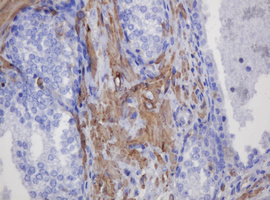 IHC of paraffin-embedded Carcinoma of Human prostate tissue using anti-FNDC4 mouse monoclonal antibody.