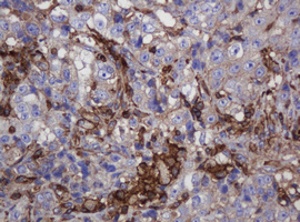 IHC of paraffin-embedded Adenocarcinoma of Human colon tissue using anti-FNDC4 mouse monoclonal antibody.