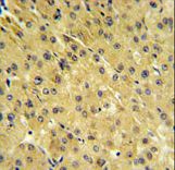 PSMAL Antibody IHC of formalin-fixed and paraffin-embedded hepatocarcinoma followed by peroxidase-conjugated secondary antibody and DAB staining.