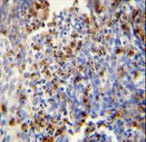 FOSL2 antibody immunohistochemistry of formalin-fixed and paraffin-embedded human lung carcinoma followed by peroxidase-conjugated secondary antibody and DAB staining.