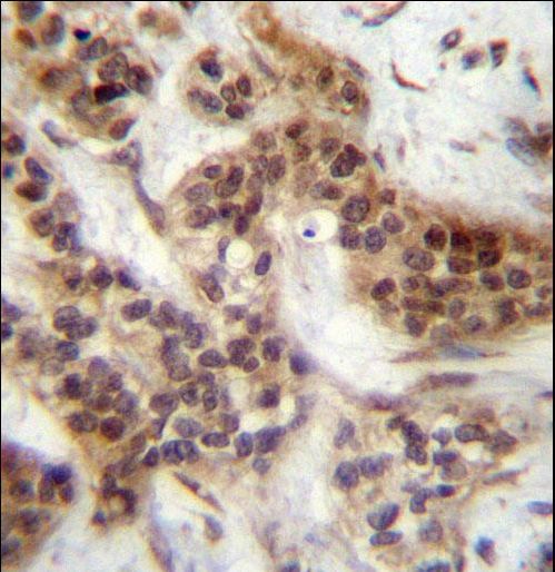 FOXA2 Antibody (Center T156) immunohistochemistry of formalin-fixed and paraffin-embedded human bladder carcinoma followed by peroxidase-conjugated secondary antibody and DAB staining.