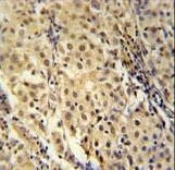 FOXC2 Antibody (Center S174) immunohistochemistry of formalin-fixed and paraffin-embedded human cervix carcinoma followed by peroxidase-conjugated secondary antibody and DAB staining. This data demonstrates the use of the FOXC2 Antibody (Center S174) for immunohistochemistry.