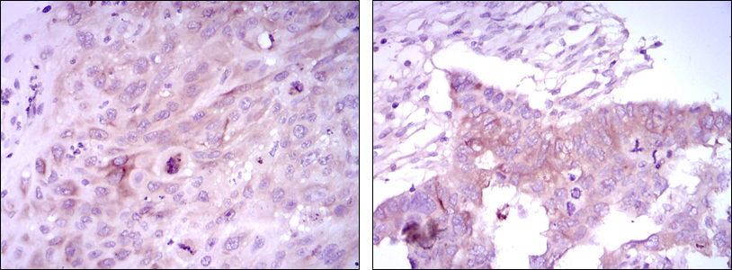 IHC of paraffin-embedded lung cancer tissues (left) and ovarian cancer tissues (right) using FOXD3 mouse monoclonal antibody with DAB staining.