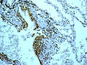 IHC of paraffin-embedded human lung tissue using anti-FOXE1 antibody.