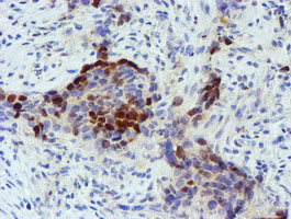 IHC of paraffin-embedded Carcinoma of Human lung tissue using anti-FOXI1 mouse monoclonal antibody.