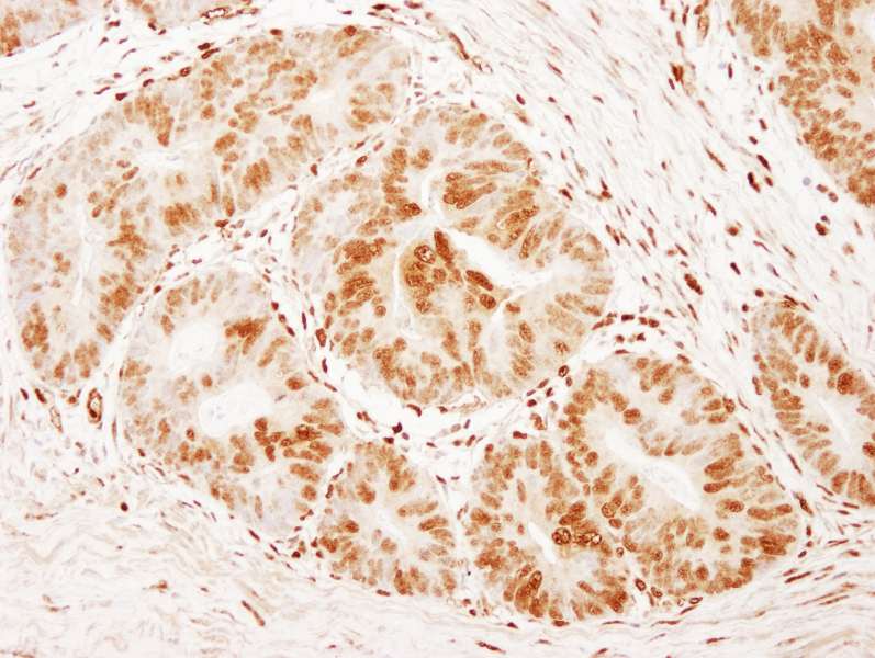 Detection of Human FOXK1 by Immunohistochemistry. Sample: FFPE section of human colon carcinoma. Antibody: Affinity purified rabbit anti-FOXK1 used at a dilution of 1:1000 (1 ug/ml). Detection: DAB.
