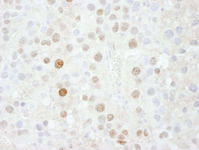 Detection of Mouse FOXK1 by Immunohistochemistry. Sample: FFPE section of mouse renal cell carcinoma. Antibody: Affinity purified rabbit anti-FOXK1 used at a dilution of 1:500.