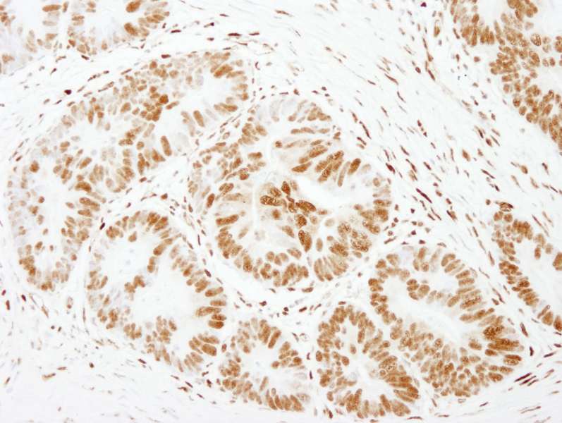 Detection of Human FOXK1 by Immunohistochemistry. Sample: FFPE section of human colon carcinoma. Antibody: Affinity purified rabbit anti-FOXK1 used at a dilution of 1:500.