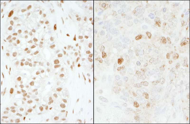 Detection of Human and Mouse FOXK1 by Immunohistochemistry. Sample: FFPE section of human breast carcinoma (left) and mouse teratoma (right). Antibody: Affinity purified rabbit anti-FOXK1 used at a dilution of 1:1000 (0.2 ug/ml) and 1:200 (1 ug/ml). Detection: DAB.